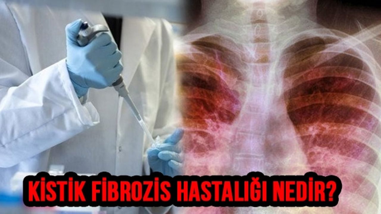 Kistik Fibrozis Hastalığı Nedir