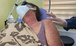 Van'da ‘beyazlatıcı krem' faciası: 4 kişi hastanelik oldu