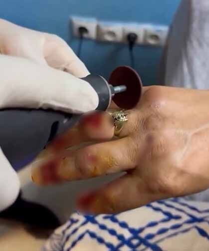 Van’da kadının parmağında sıkışan yüzük kesilerek çıkarıldı!